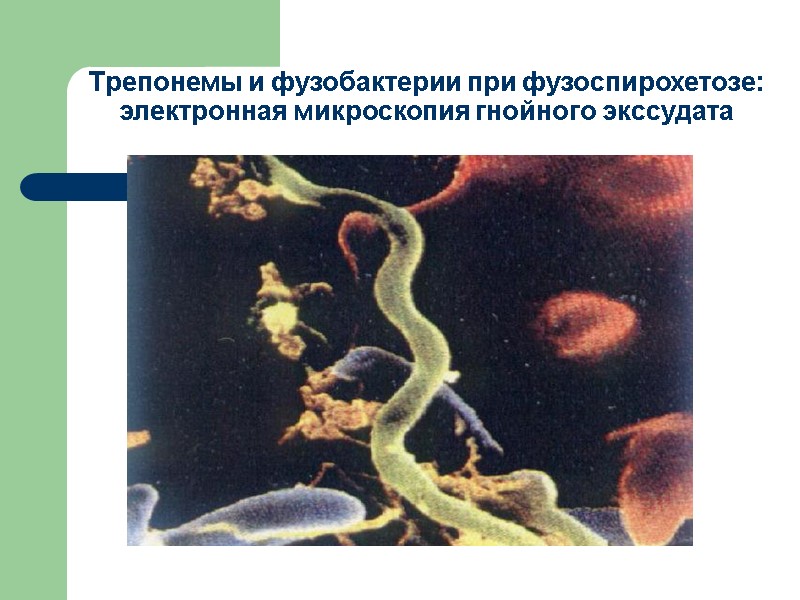 Трепонемы и фузобактерии при фузоспирохетозе:  электронная микроскопия гнойного экссудата